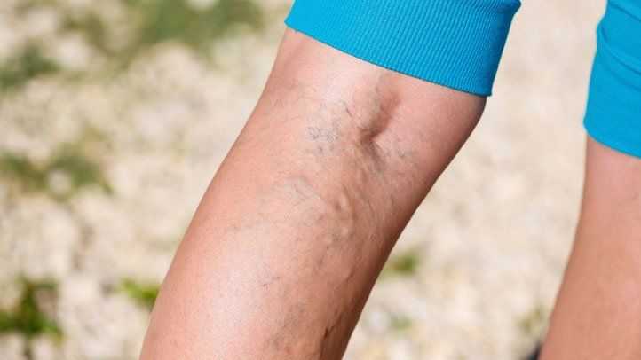 All You Need to Know About Spider Veins
