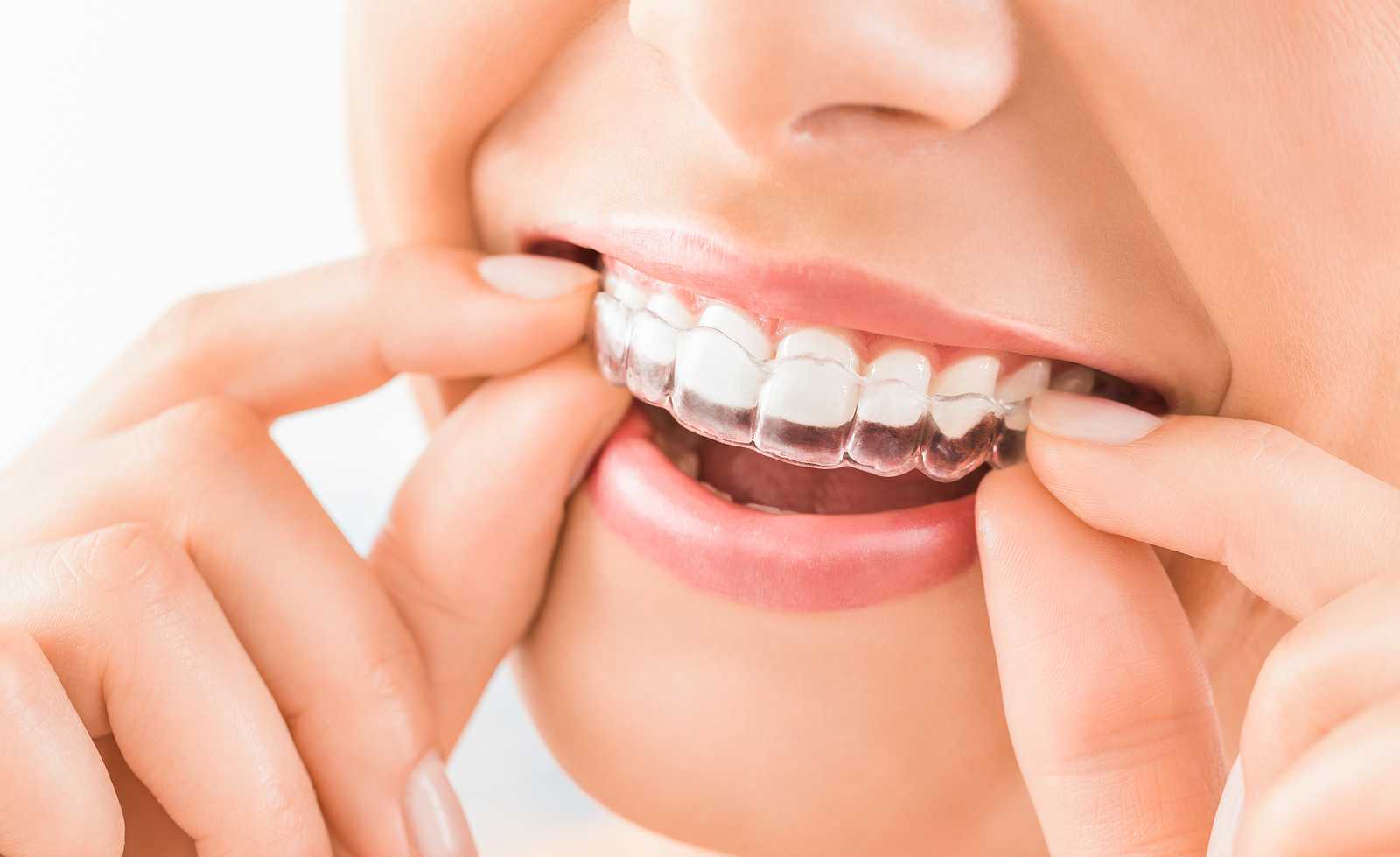 Top 5 Benefits of Clear Aligners