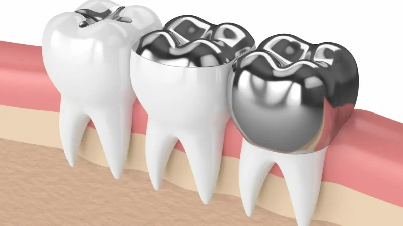 5 Different Styles of Dental Fillings to Consider for Dental Care