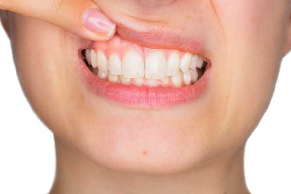 Cosmetic Gum Surgery Top Benefits