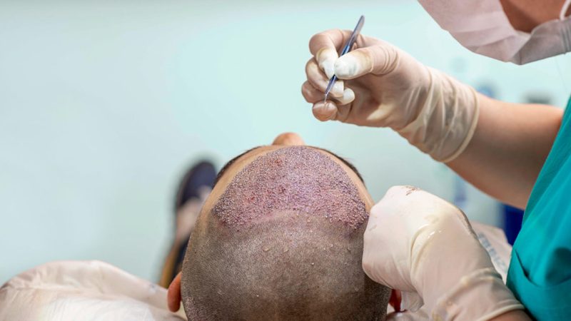 Why You Should Choose Scalp Micropigmentation over Hair Transplantation