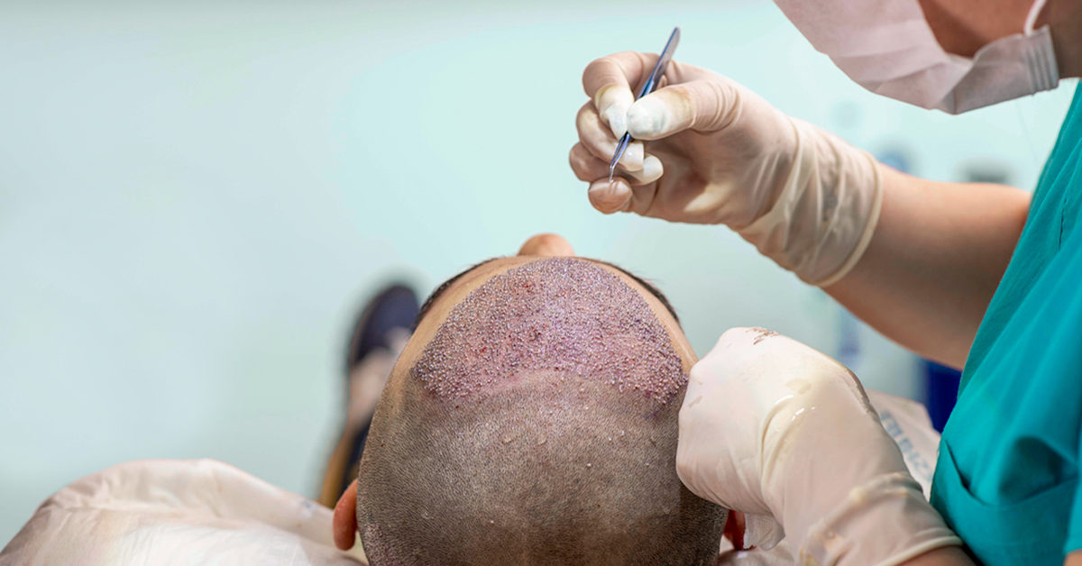 Why You Should Choose Scalp Micropigmentation over Hair Transplantation