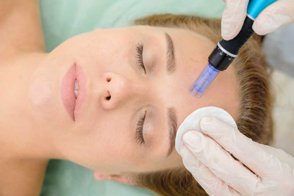 All You Need to Know About Microneedling