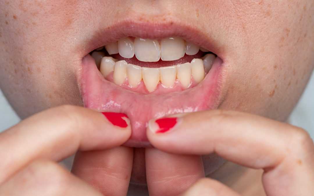 5 Simple Ways to Stop Gum Recession