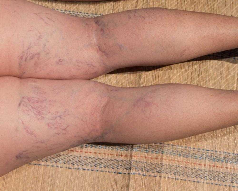 5 Risk Factors for Varicose Veins