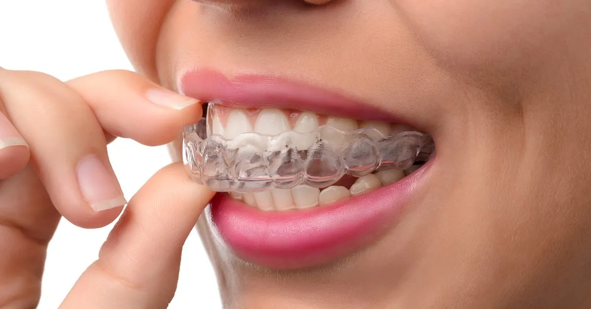 What to Expect from Your Clear Aligners Appointment