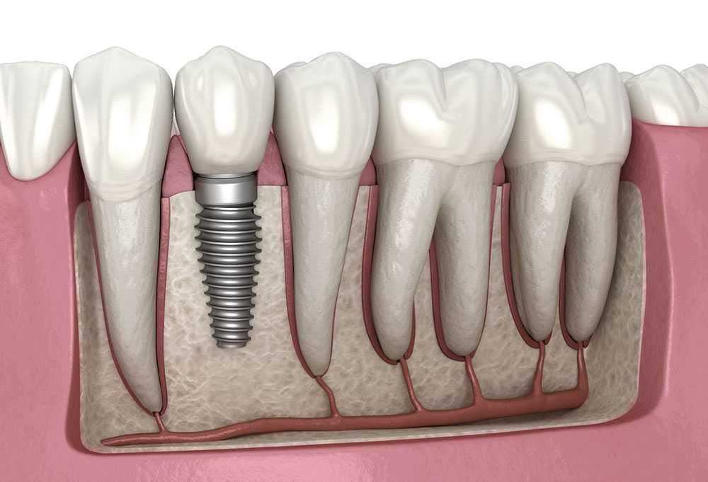 The Reasons Behind Dental Implants’ Increasing Popularity