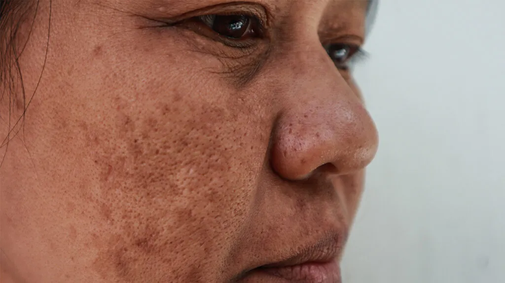 Side Effects of The Melasma Medications