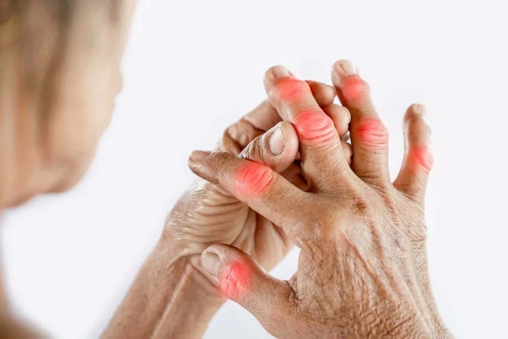 How to Live with Arthritis