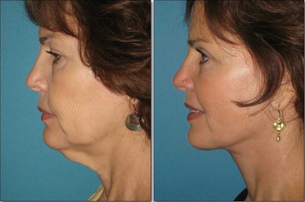 Restore Your Youthful Appearance With Face And Neck Lift