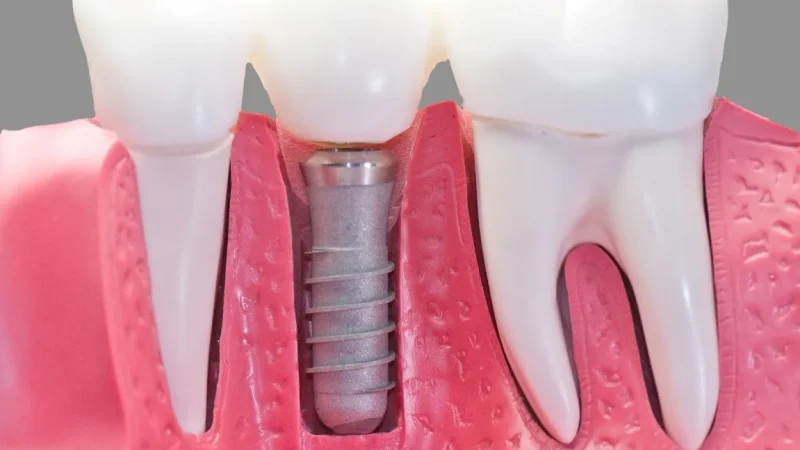What Are the Benefits of Choosing a Dental Implant Over a Traditional Fixed Bridge? 