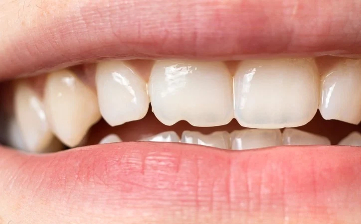 Is It Possible to Repair a Cracked or Chipped Tooth in Vista?