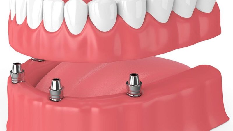 Which is Best for You: Partial Dentures vs. Dental Implants?