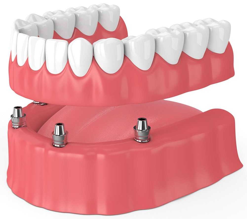 Which is Best for You: Partial Dentures vs. Dental Implants?