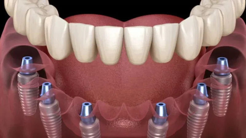 Can You Benefit from Dental Implants in Plymouth, MA?