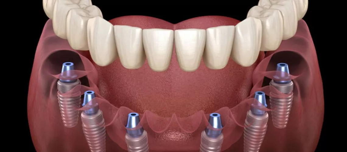 Can You Benefit from Dental Implants in Plymouth, MA?