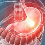 Preparing for a Gastroscopy