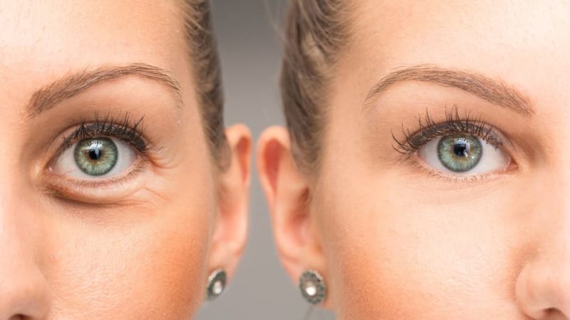 Can Crow’s Feet Be Treated with the Help of Botox?