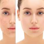 Pigmentation Removal Made Easy
