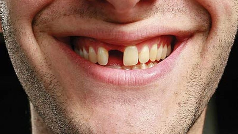 What are the options for missing teeth?