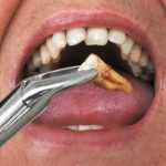 Recovery from Tooth Extraction
