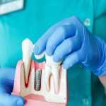 dental implant procedure