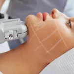 HIFU Treatment