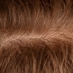 itchy scalp