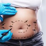 Non-Surgical Fat Reduction
