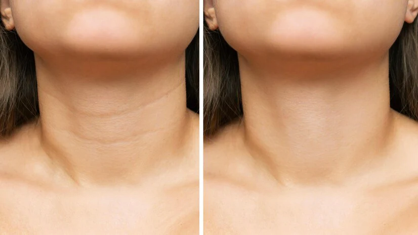 Smoother Profiles With Neck Lines Treatment That Works Today