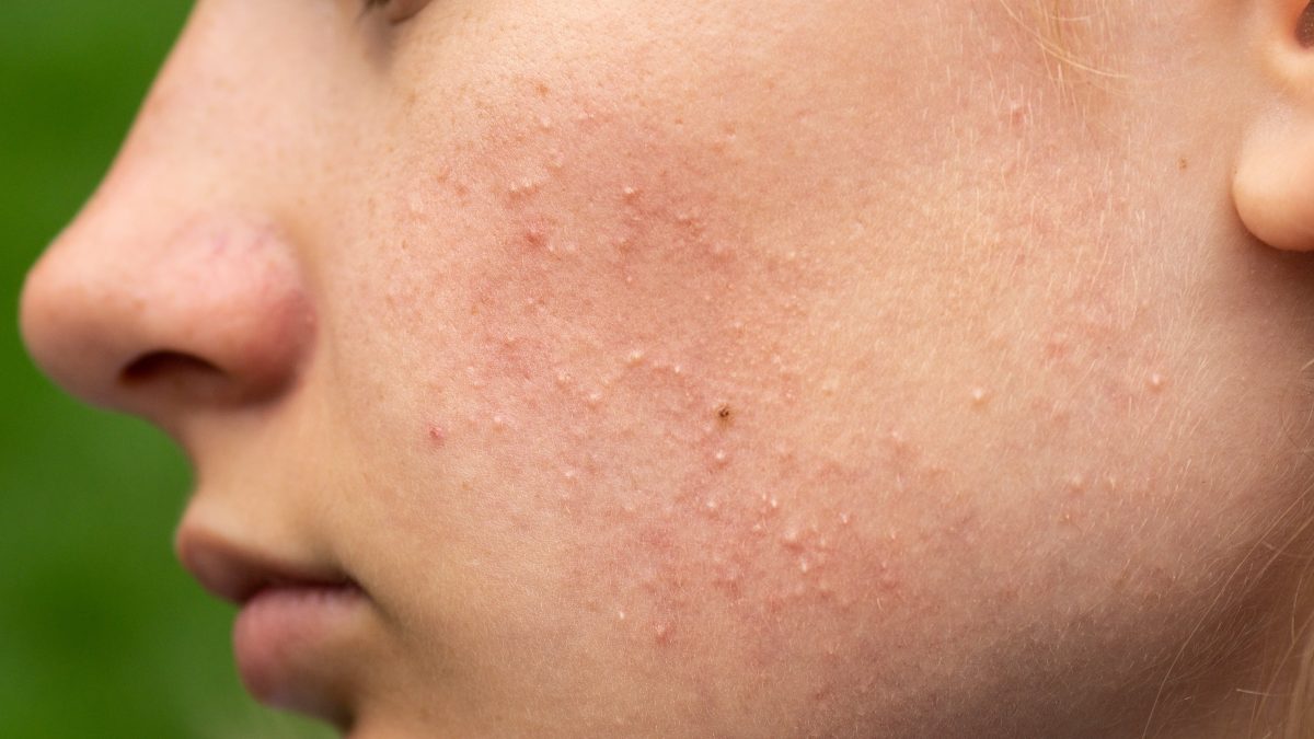 Comedones Explained: Causes, Types, and How to Treat Them Safely