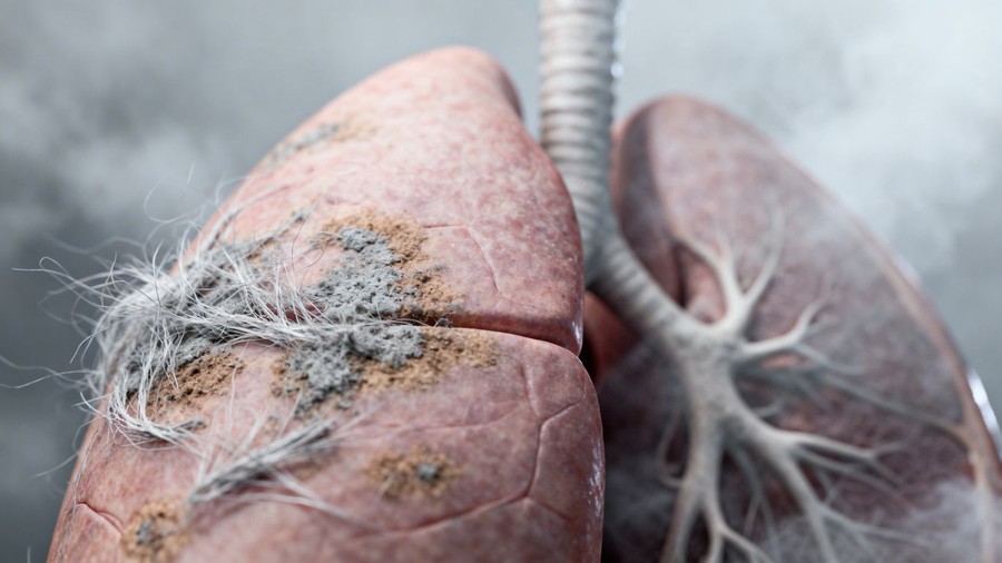 Understanding Prognosis With Lung Cancer From Asbestos