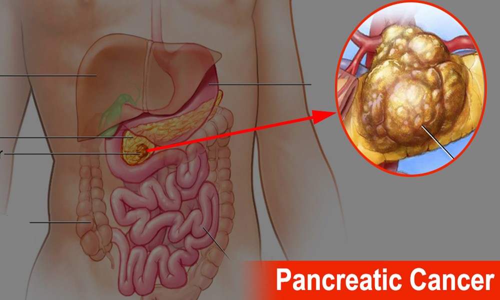 Pancreatic Cancer Surgery and Treatment Options in Singapore