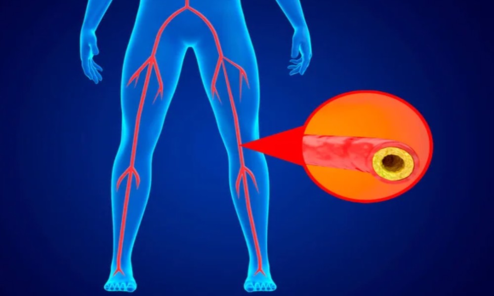 How to Manage Peripheral Arterial Disease Early
