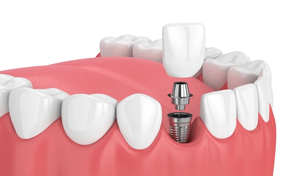 Bone Health and Dental Implants: Why Jawbone Strength Matters Before Choosing Dental Implants